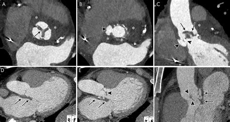 Role Of Cardiac Ct In Infective Endocarditis Current Evidence