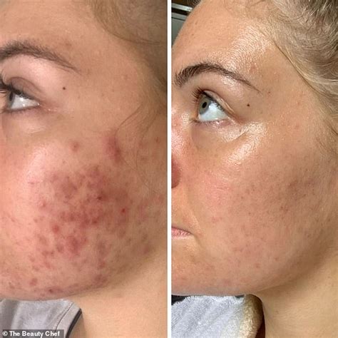 Young Woman Who Struggled With Severe Cystic Acne For Years Reveals