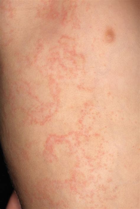 Erythematous Papules And Plaques On The Flank Of A Child Mdedge