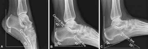 Calcaneal Radiography In Different Positions In A Male Volunteer 28