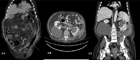 Ct Abdomen And Pelvis Without Contrast Coronal View Fig 2 A Showed