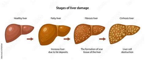 Stages Of Liver Damage With Description Corresponding Steps Healthy