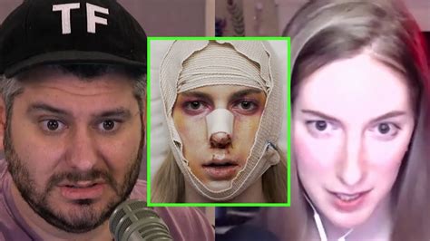 Contrapoints Talks On The Trauma Of Trans Facial Surgery Youtube