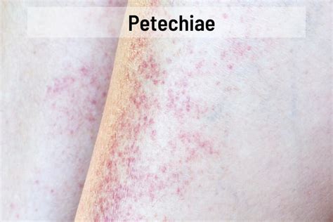 Cherry Angioma Vs Petechiae Whats The Difference