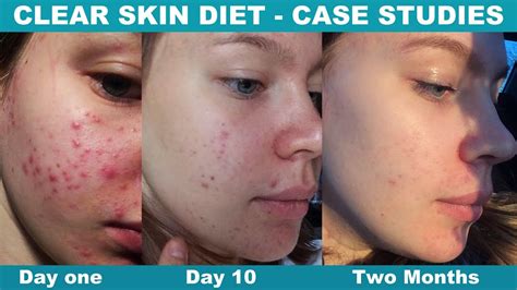 Change Your Diet Clear Your Acne Olyabrand