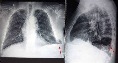 Xrays Of Broken Ribs