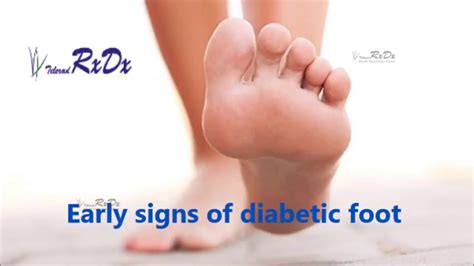 Early Signs Of Diabetic Foot Youtube