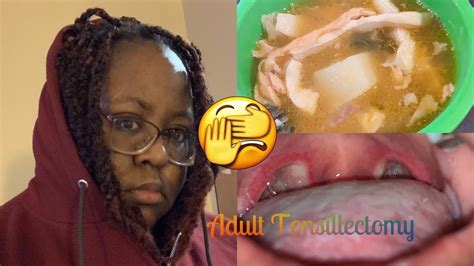 My Adult Tonsillectomy And Adenoidectomy Recovery Youtube
