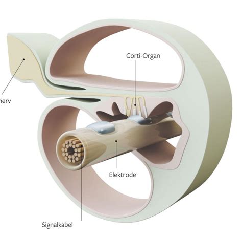 Cochlea Implantat Diese Prothese Macht Gehörlose Zu Hörenden Welt