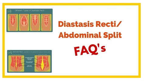 What Causes Diastasis Recti Your Best Options To Fix It Youtube