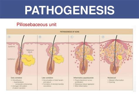 Pathophysiology Of Acne