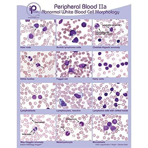 Peripheral Blood Poster Abnormal Wbc Morphology Poster Superior Design