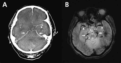 Figure 1 From Pseudo Subarachnoid Hemorrhage Demonstrated By T2