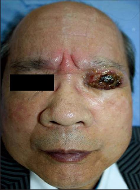 Primary Cutaneous Aggressive Epidermotropic Cd8 T Cell Lymphoma On
