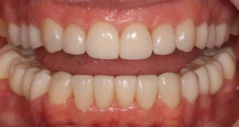 Before And After 3d Dental Impressions And Full Mouth Reconstruction