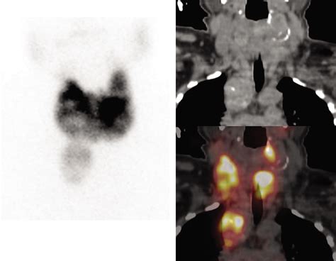 Camouflaged Asymptomatic Mediastinal Thyroid Ectopia In A Patient With