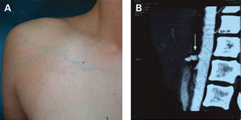 A 14 Year Old Girl With A Sudden Arm Swelling After Axillary Depilatory