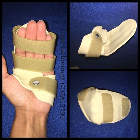Static Dorsal Blocking Orthosis Hand Therapy Orthosis Occupational