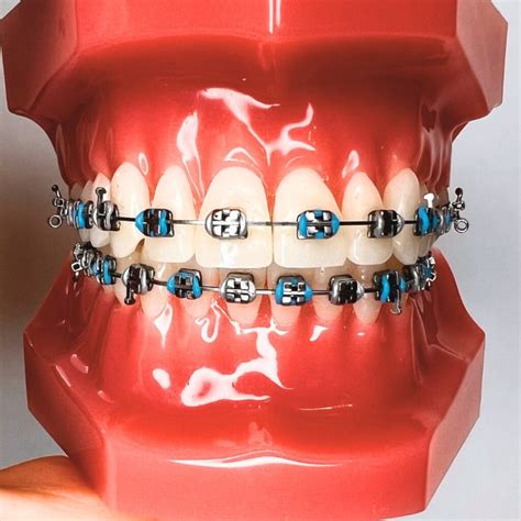 Silver Braces 7 Color Combos To Spice Things Up