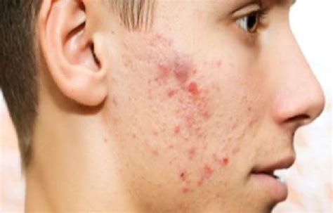 Bekas jerawat di wajah juga akan menimbulkan bintik hitam di wajah. Cara menghilangkan Flek Hitam Bekas Jerawat