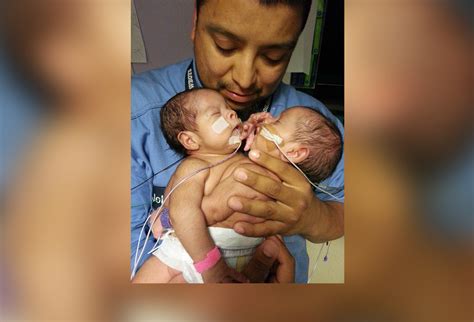 Having Hope And Faith Inside Dramatic Surgery To Separate Conjoined Texas Twins Abc News