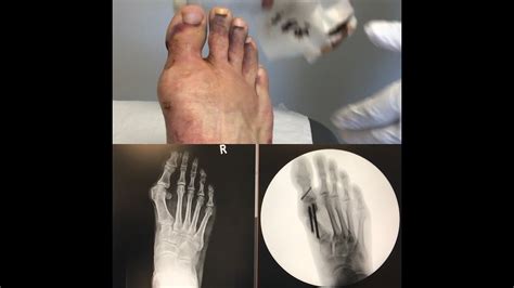 Keyhole Bunion Surgery The Naked Truth About Minimal Invasive Bunion Surgery My Full Recovery