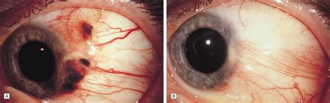 Conjunctival Melanoma Risk Factors For Recurrence Exenteration