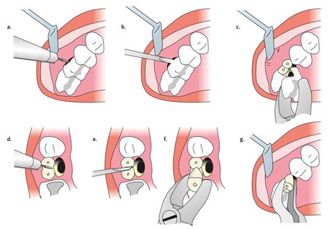 Extraction Of Maxillary First Molar With Sectioning