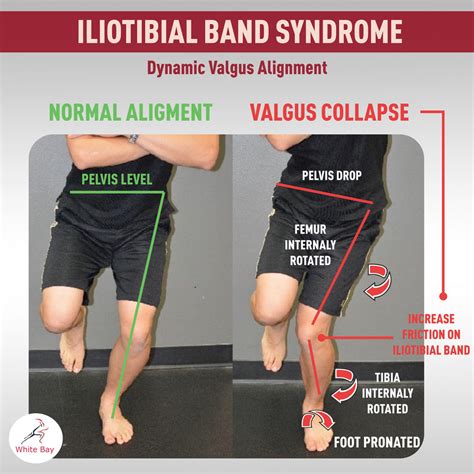 Iliotibial Band Syndrome Treatment Plan
