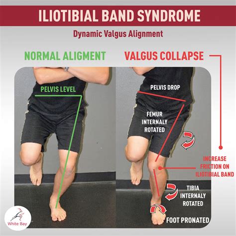 Iliotibial Band Syndrome ITBS In Soccer Players Weston Florida