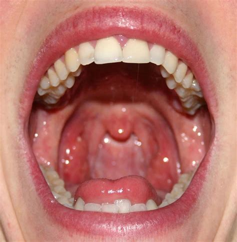 Pharyngitis Causes Symptoms Diagnosis Treatment Rxharun