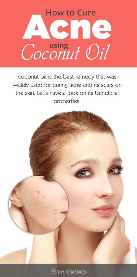 How To Use Coconut Oil For Acne Acne Cure Coconut Oil For Acne