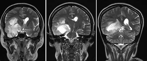 Diffuse Astrocytoma Radiology Cases