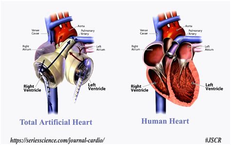 Artificial Heart Series Of Cardiology Research Cardiology