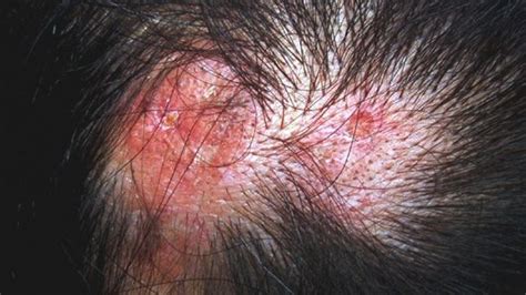 There are many varying types of skin disease that can affect a person's skin, some of which are as simple as a minor irritation while others can cause severe discomfort and even lead to infection and other illnesses. A Closer Look at Lupus (Pictures) | Discoid lupus, Sores ...