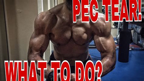 How To Treat A Torn Pectoralis Major Youtube