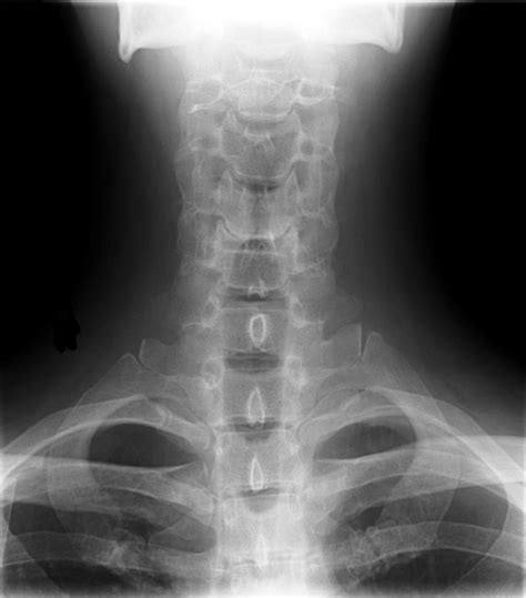 Filecervical Xray Lower Ap View Wikimedia Commons