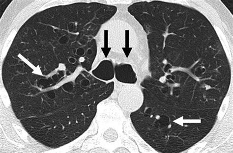 Bronchiectasis Symptoms Signs Management Geeky Medics