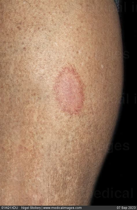 Stock Image Dermatology Tinea Corporis Ringworm An Oval Patch Of Pink