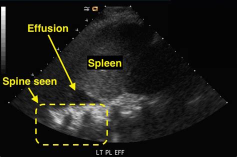 Spine Sign On Ultrasound