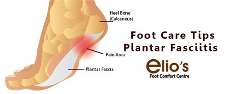 Plantar Fasciitis Treatments Niagara Elios Foot Comfort Centre