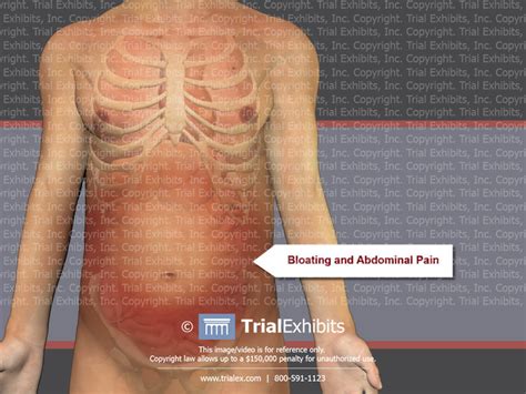 Bloating And Abdominal Pain Trial Exhibits Inc