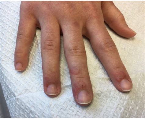 A 22 Year Old Presented With Erythematous Papules On Her Fingers And