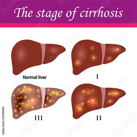 Cirrhosis Of The Liver Stages Stock Image And Royalty Free Vector