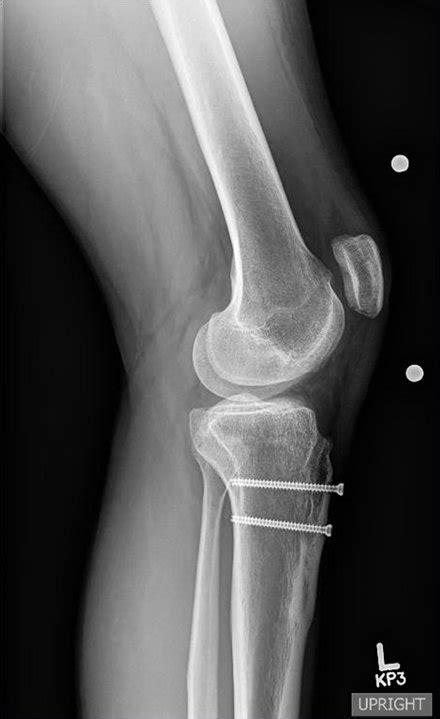 Tibial Tubercle Osteotomy Soft Tissue Stabilization May Be Required To