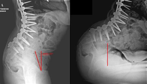 The Spinopelvic Relationship Made Simple What Every Hip Surgeon Needs