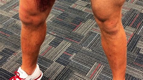 J J Watt Posted The Grossest Picture Of A Leg Bruise You’ll Ever See