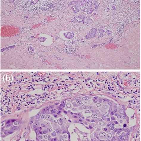 Pathological Findings Hematoxylin And Eosin Stain A ×10 No Mass