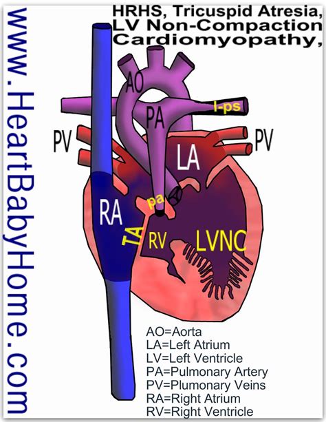 Hypoplastic Right Heart Syndrome With Non Compaction Cardi Flickr