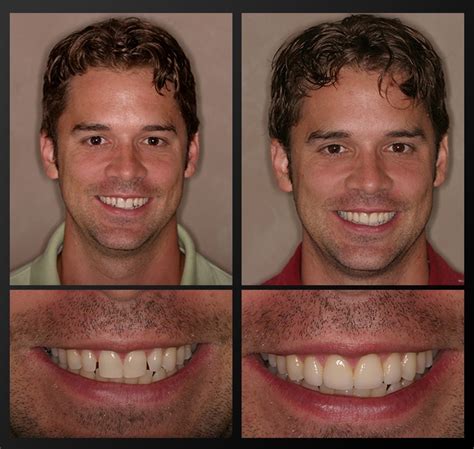 Smile Gallery Before And After Dental Photos Smile Makeovers Images